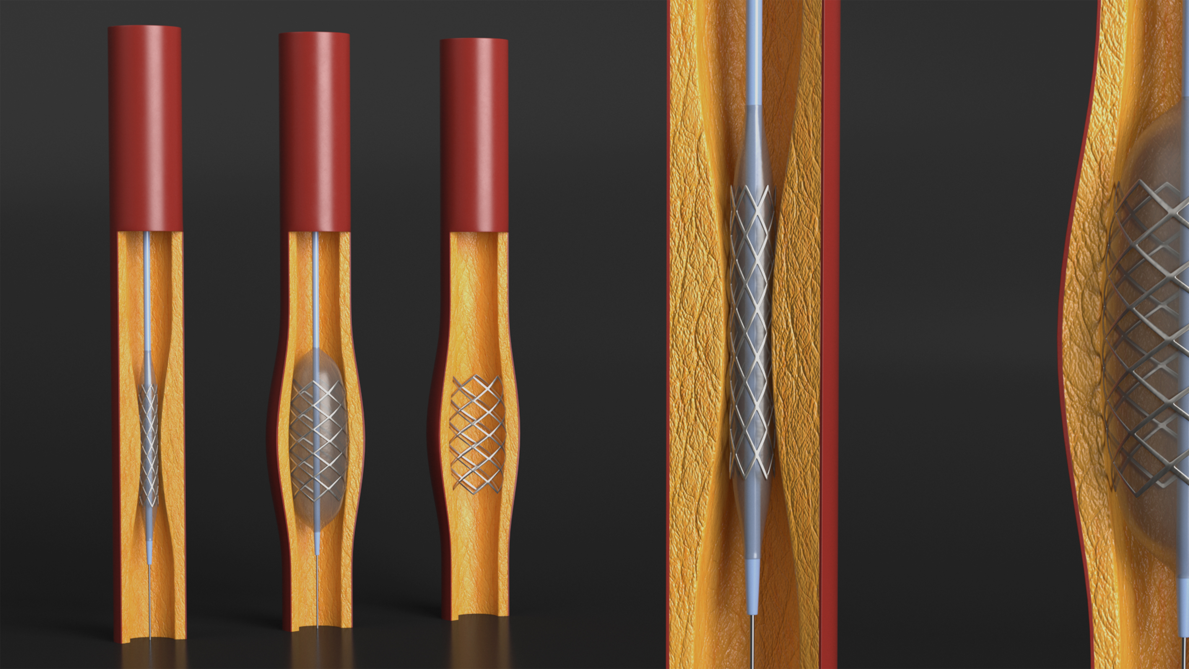 3D Plastic Models of Stents with Artery