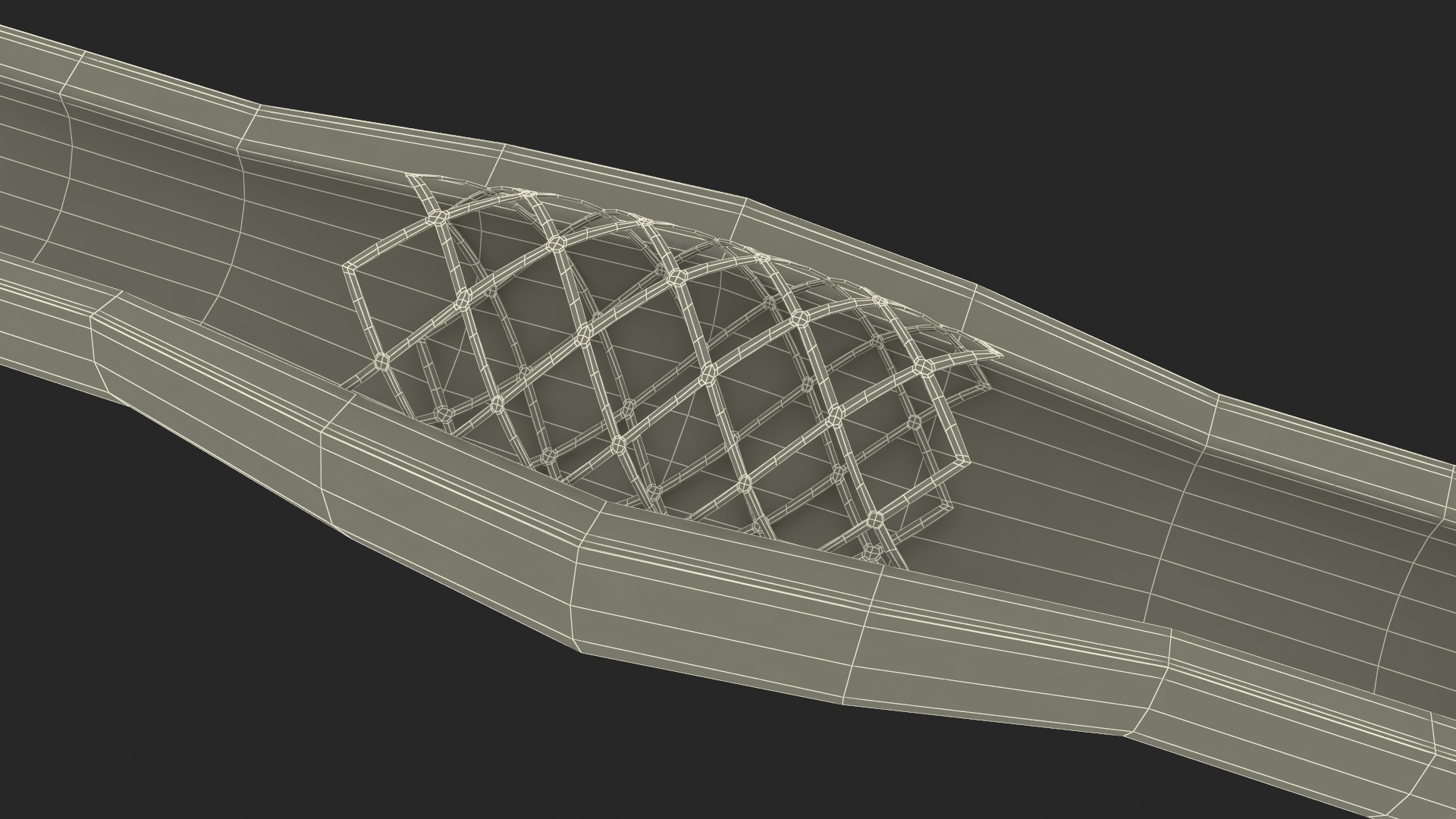3D Plastic Models of Stents with Artery