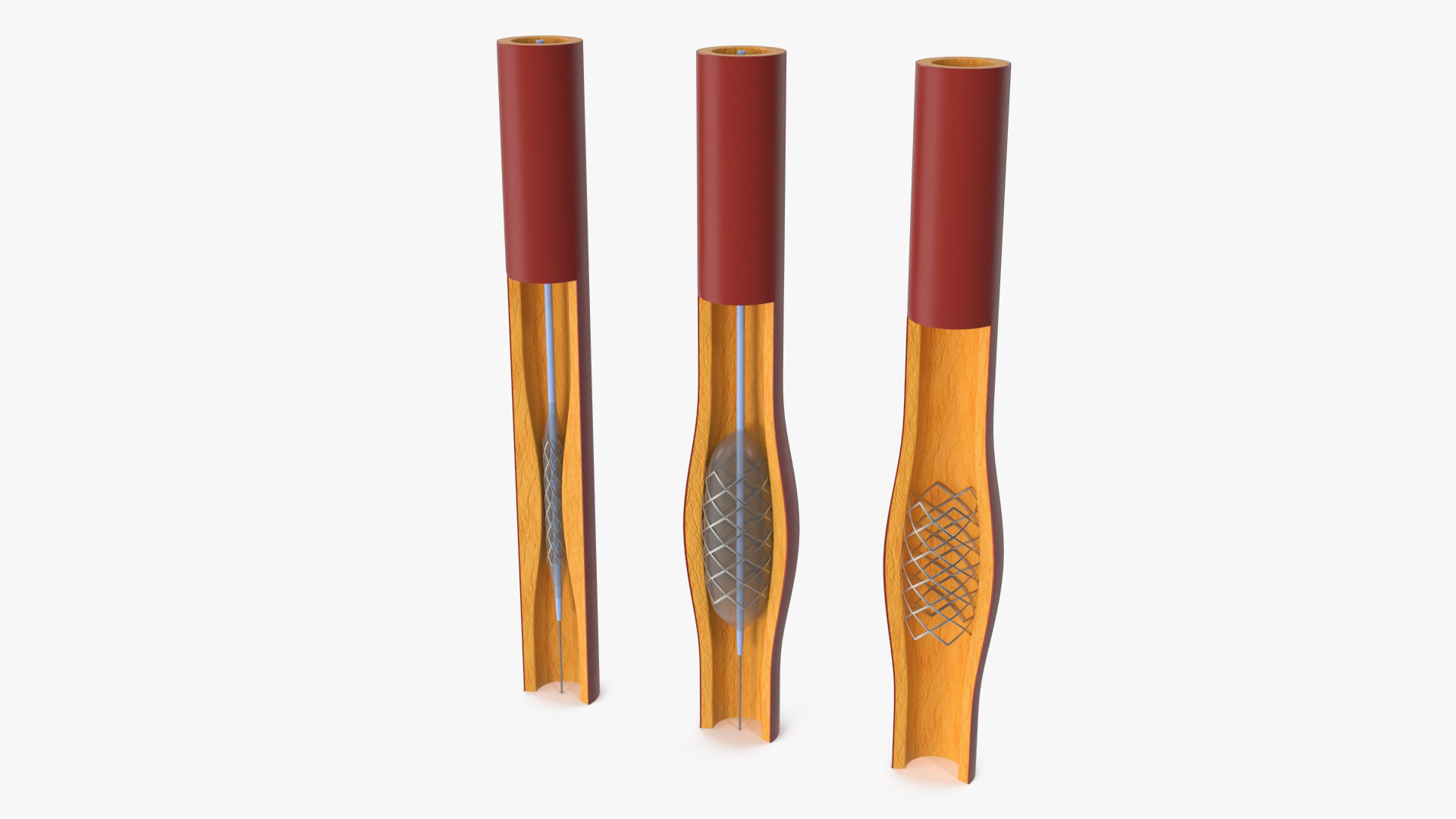 3D Plastic Models of Stents with Artery