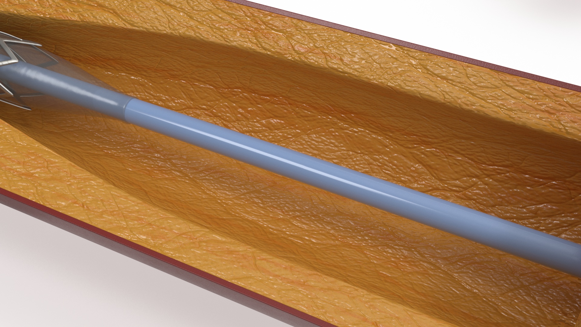 3D Plastic Models of Stents with Artery