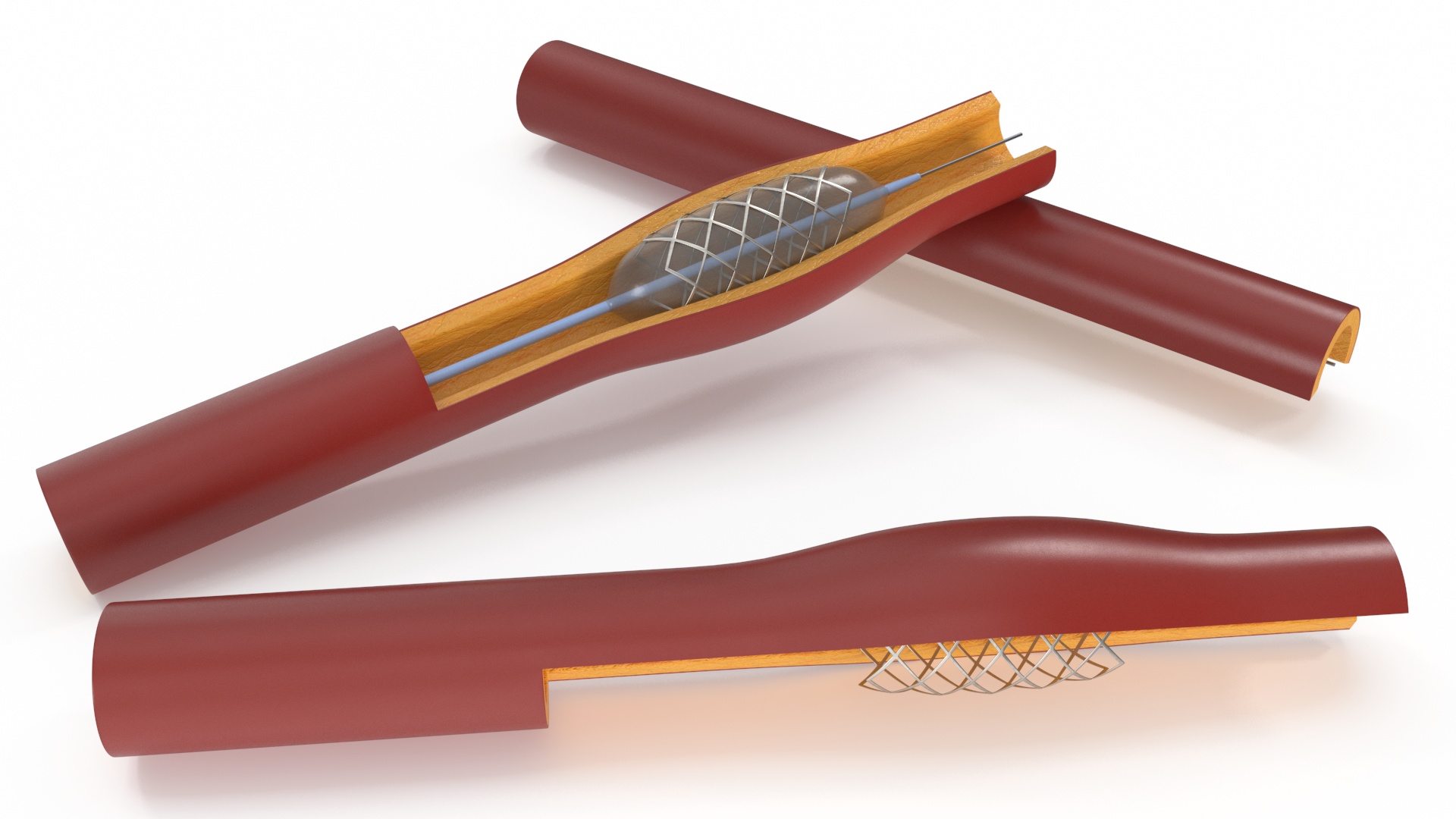 3D Plastic Models of Stents with Artery