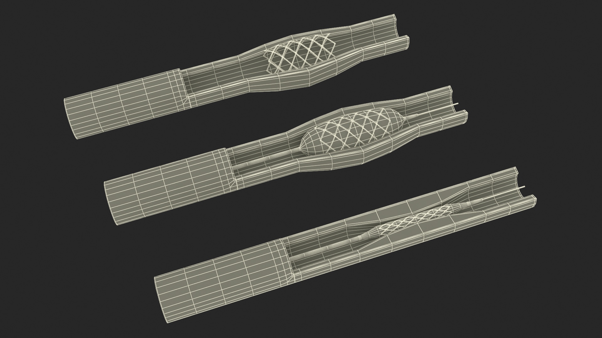 3D Plastic Models of Stents with Artery