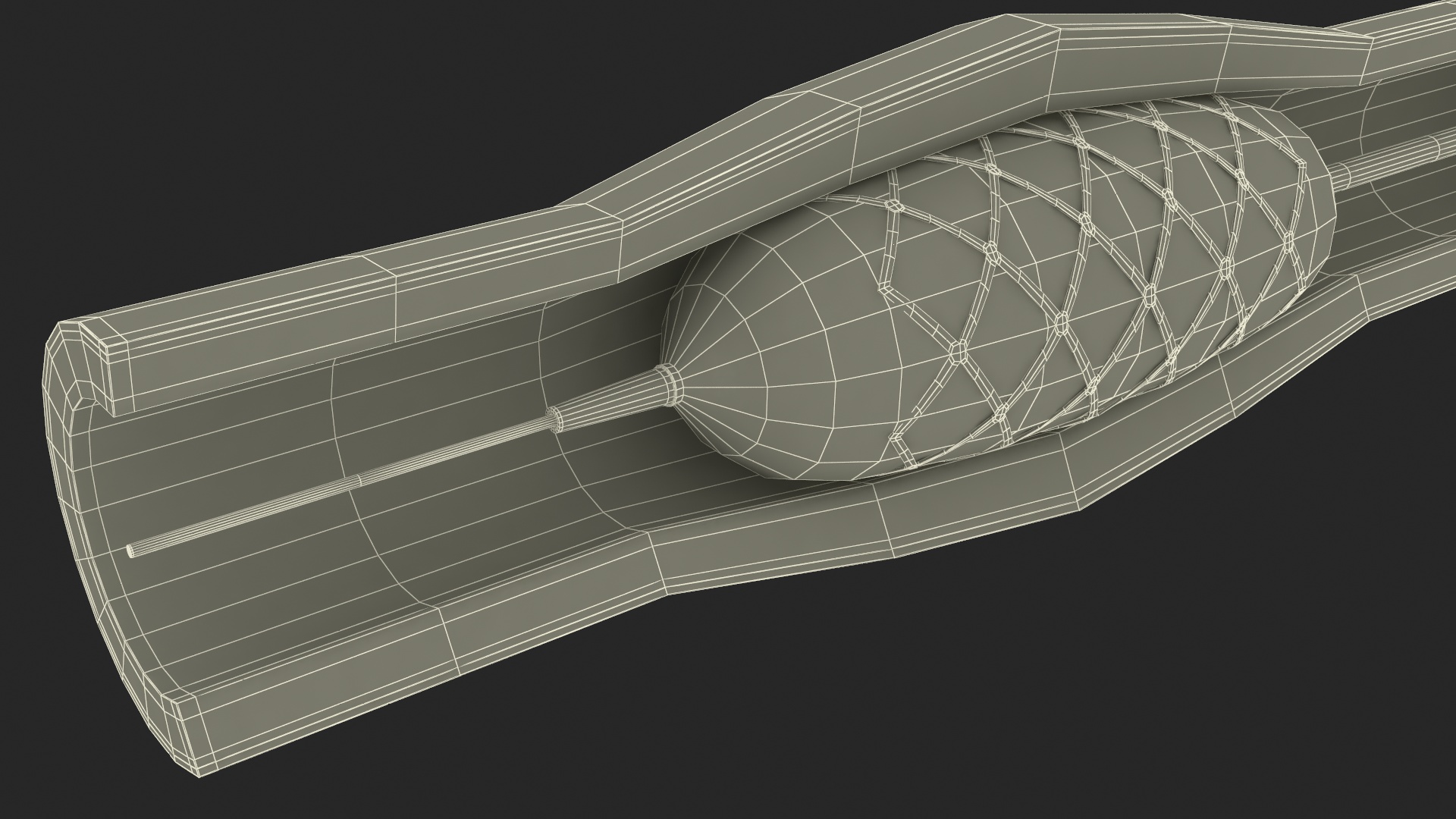 3D Plastic Models of Stents with Artery