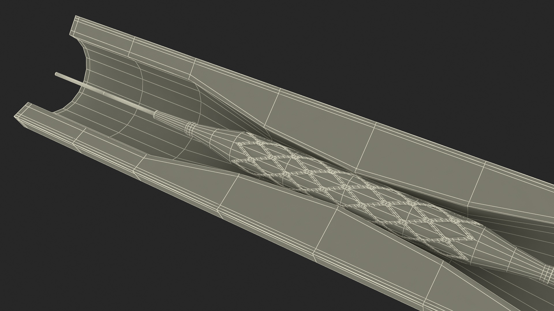 3D Plastic Models of Stents with Artery