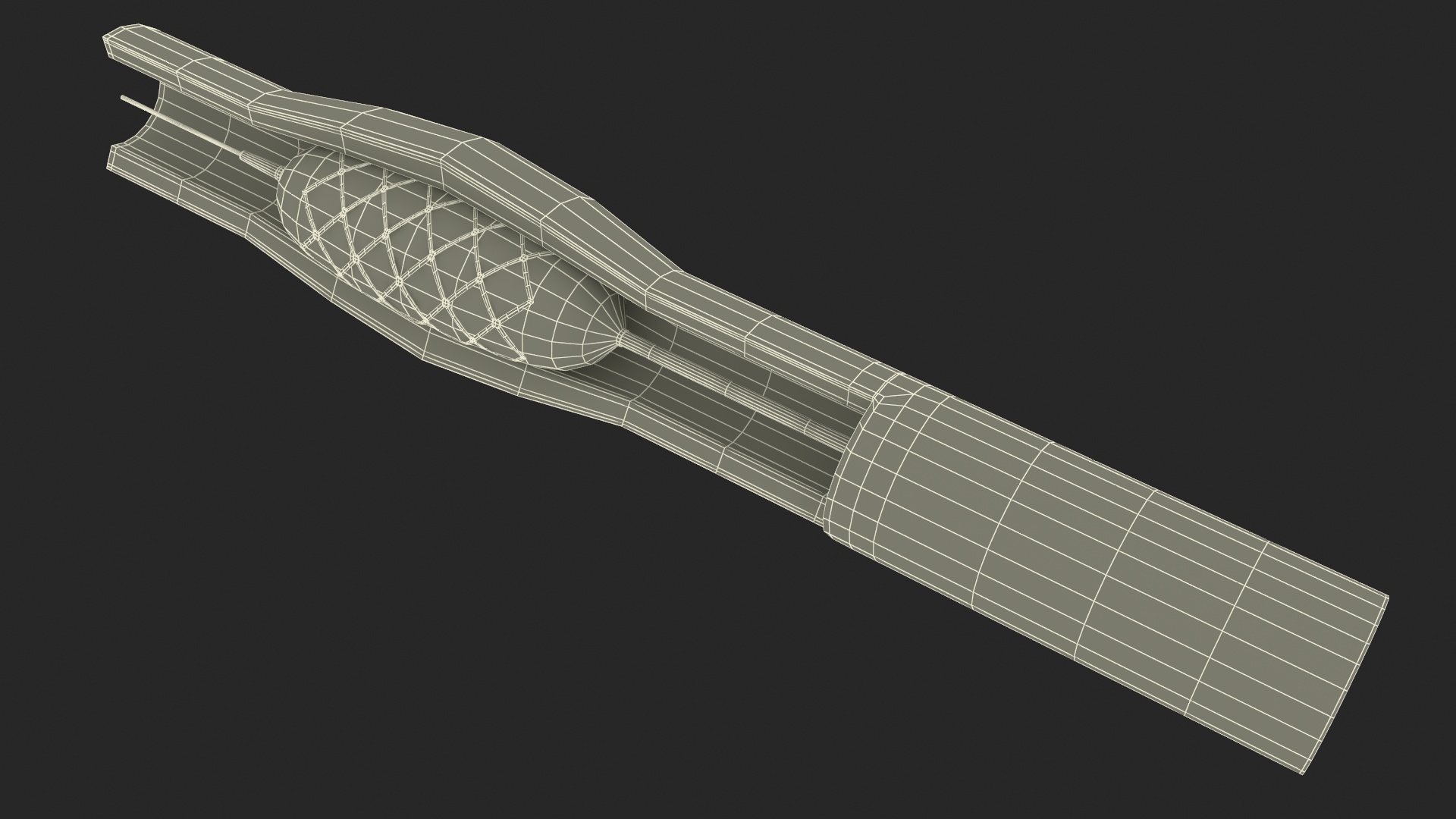 3D Plastic Models of Stents with Artery