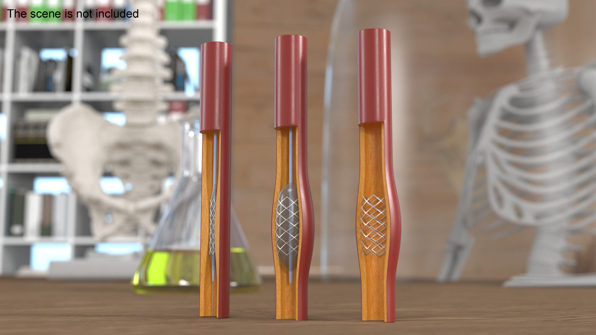 3D Plastic Models of Stents with Artery