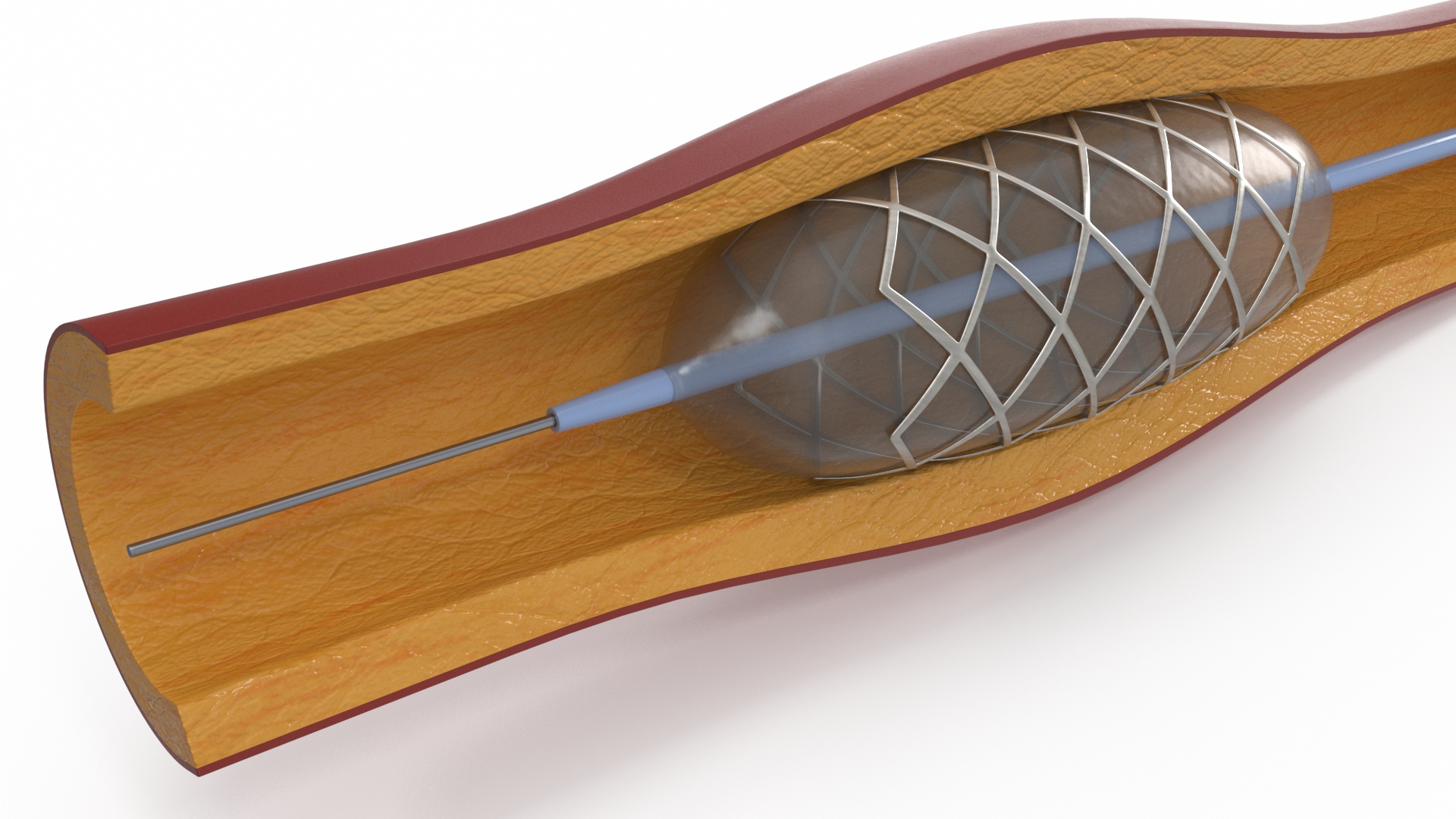 3D Plastic Models of Stents with Artery