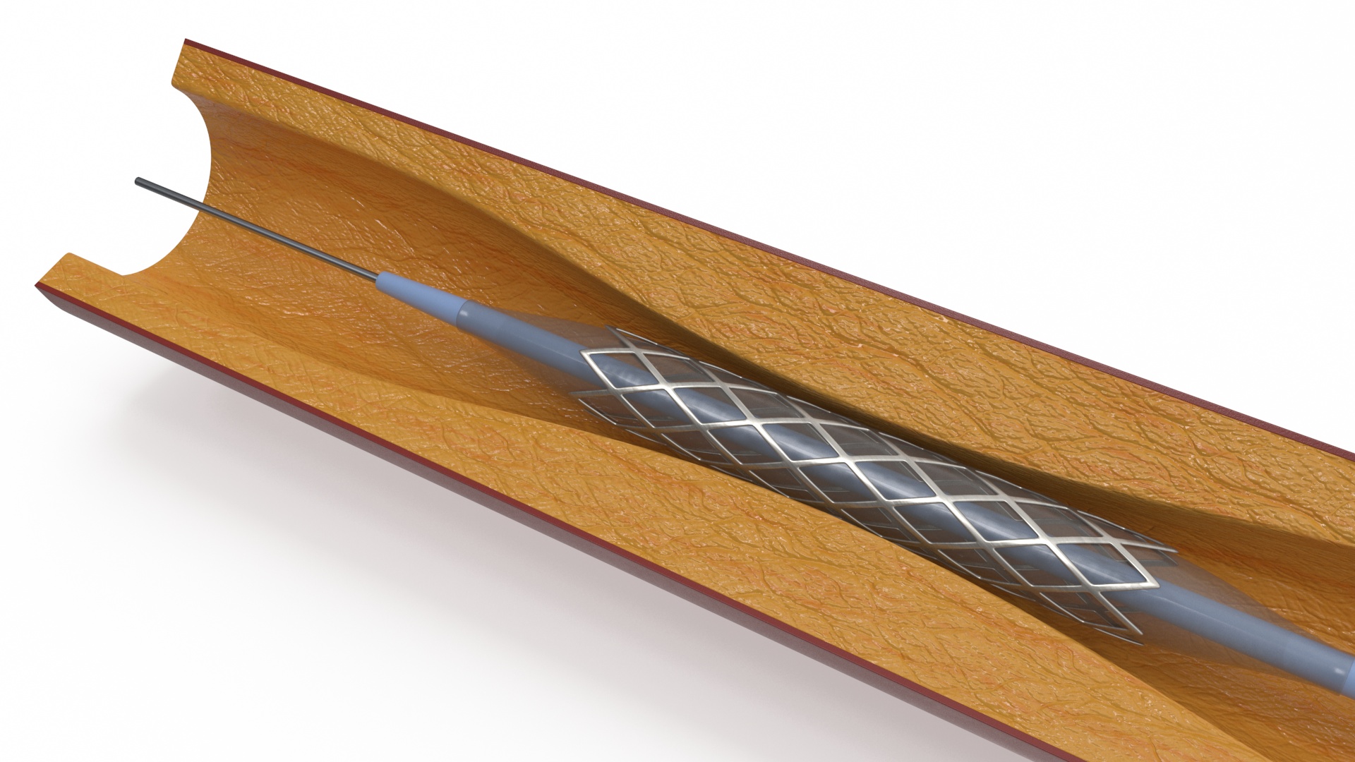 3D Plastic Models of Stents with Artery