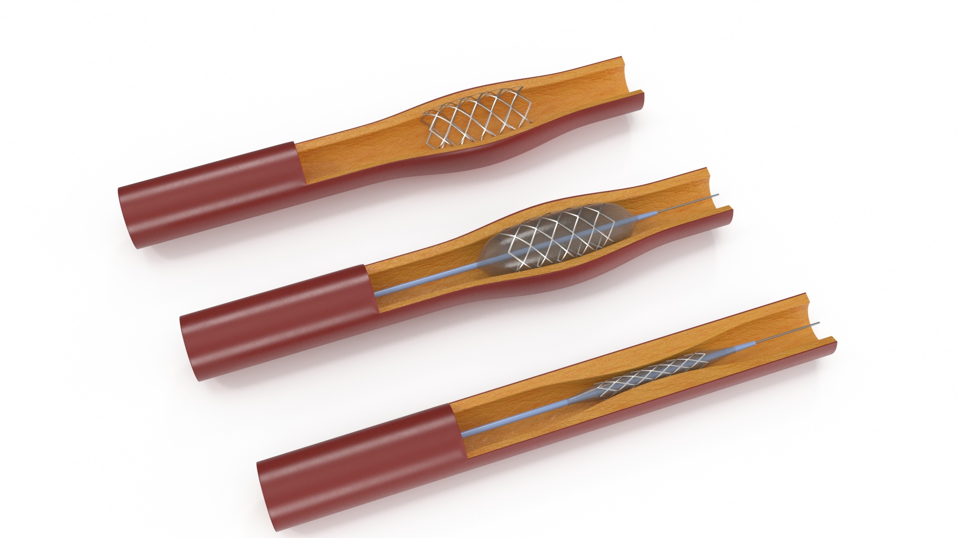 3D Plastic Models of Stents with Artery