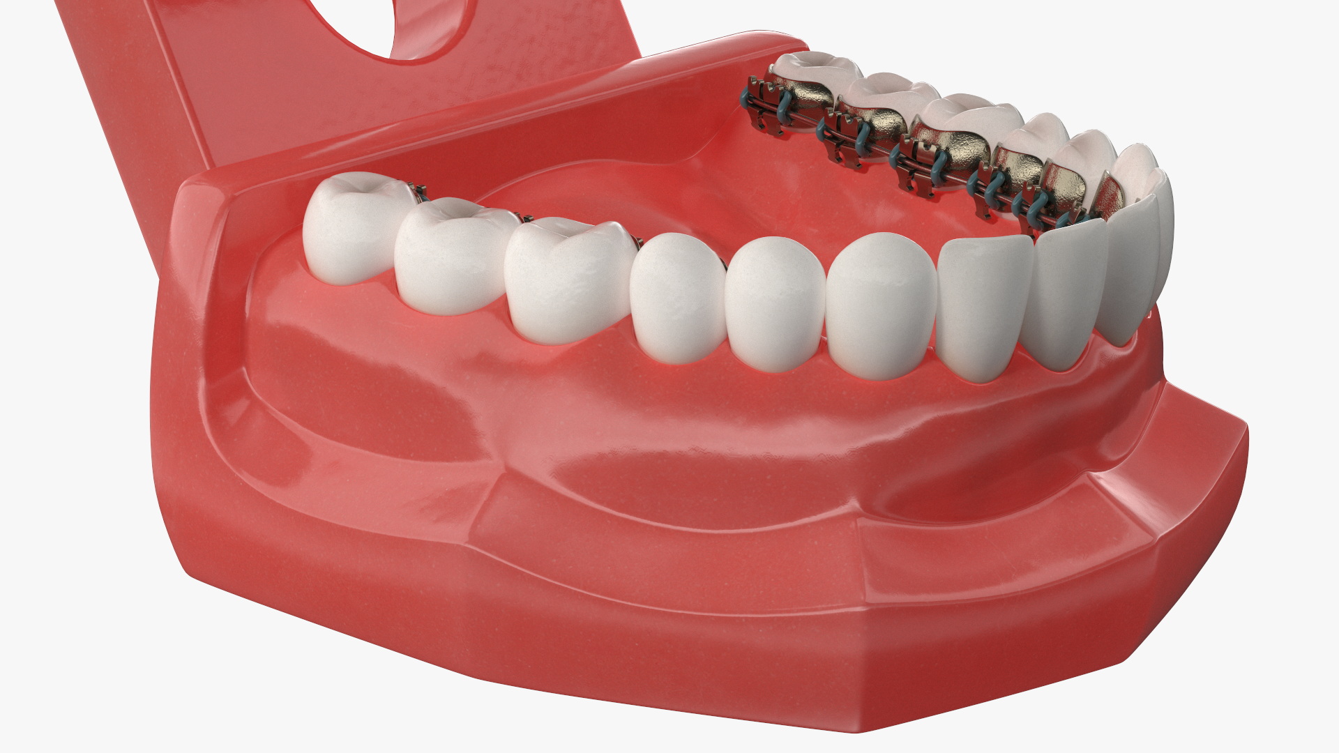 3D Lingual Braces on Typodont Teeth Model model
