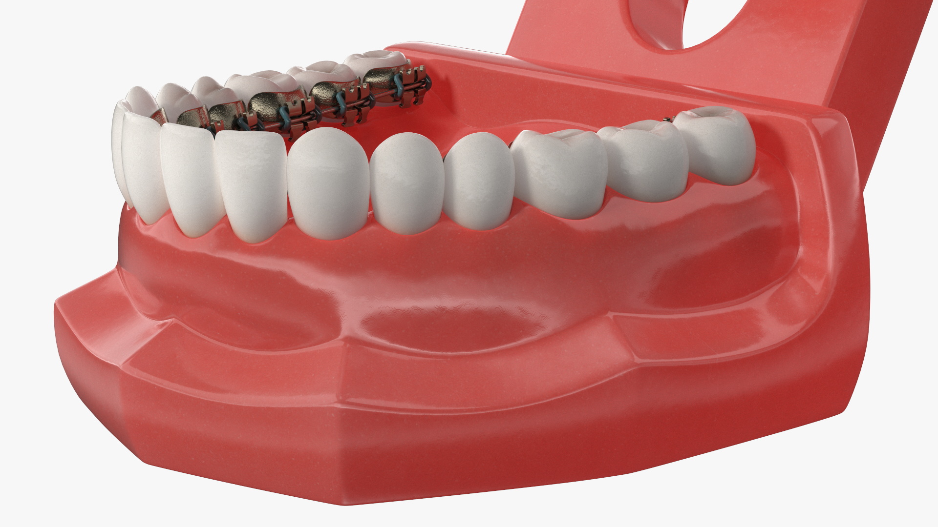 3D Lingual Braces on Typodont Teeth Model model