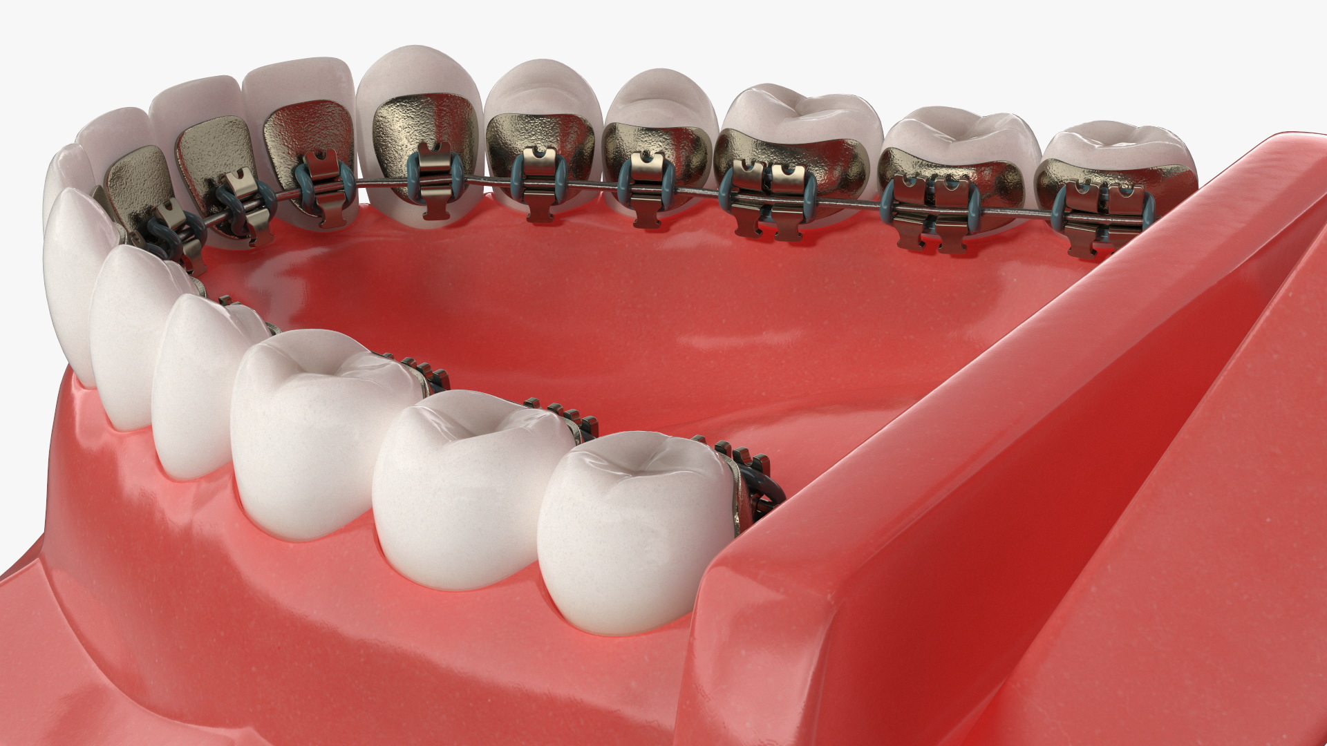 3D Lingual Braces on Typodont Teeth Model model