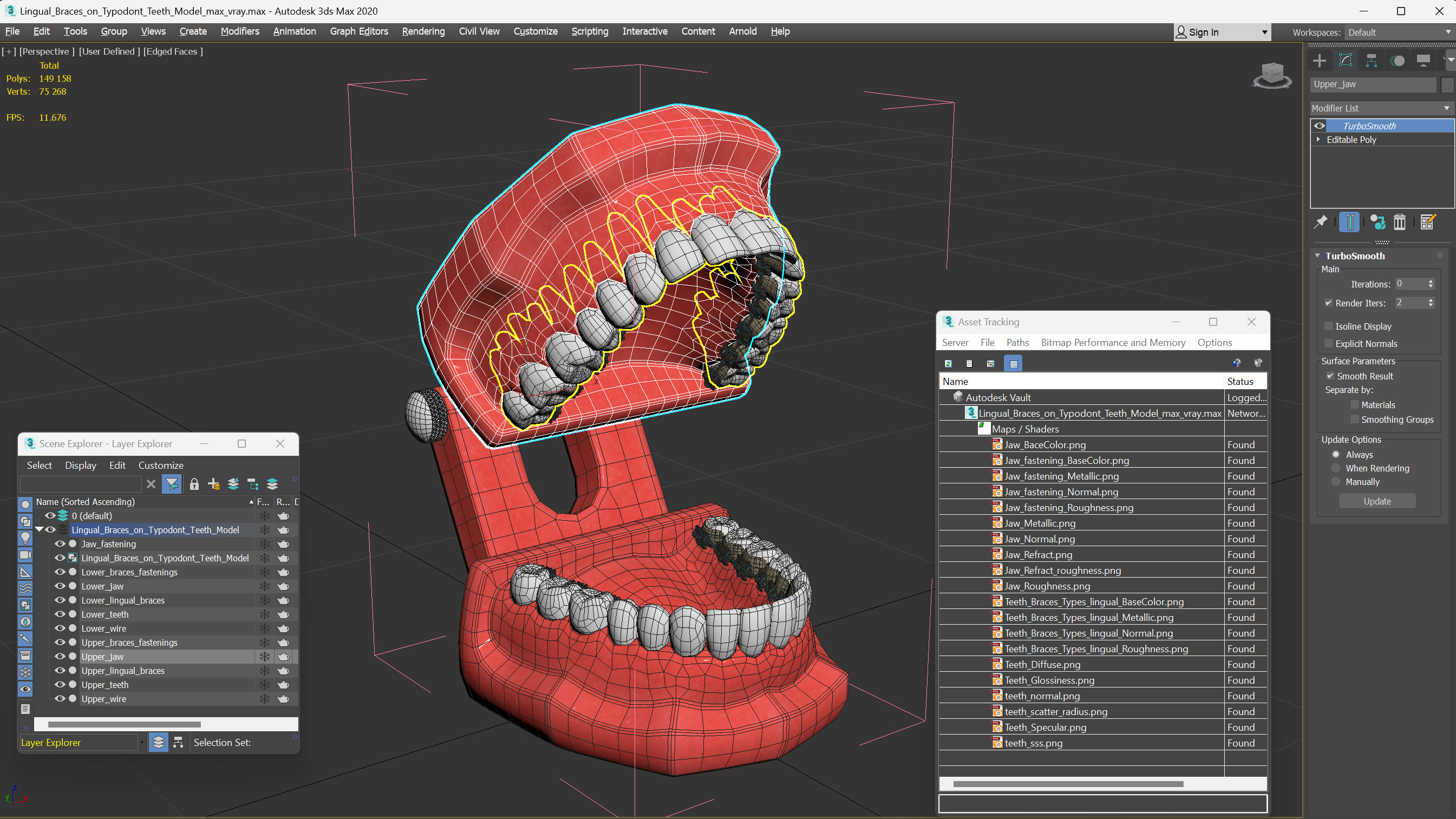 3D Lingual Braces on Typodont Teeth Model model
