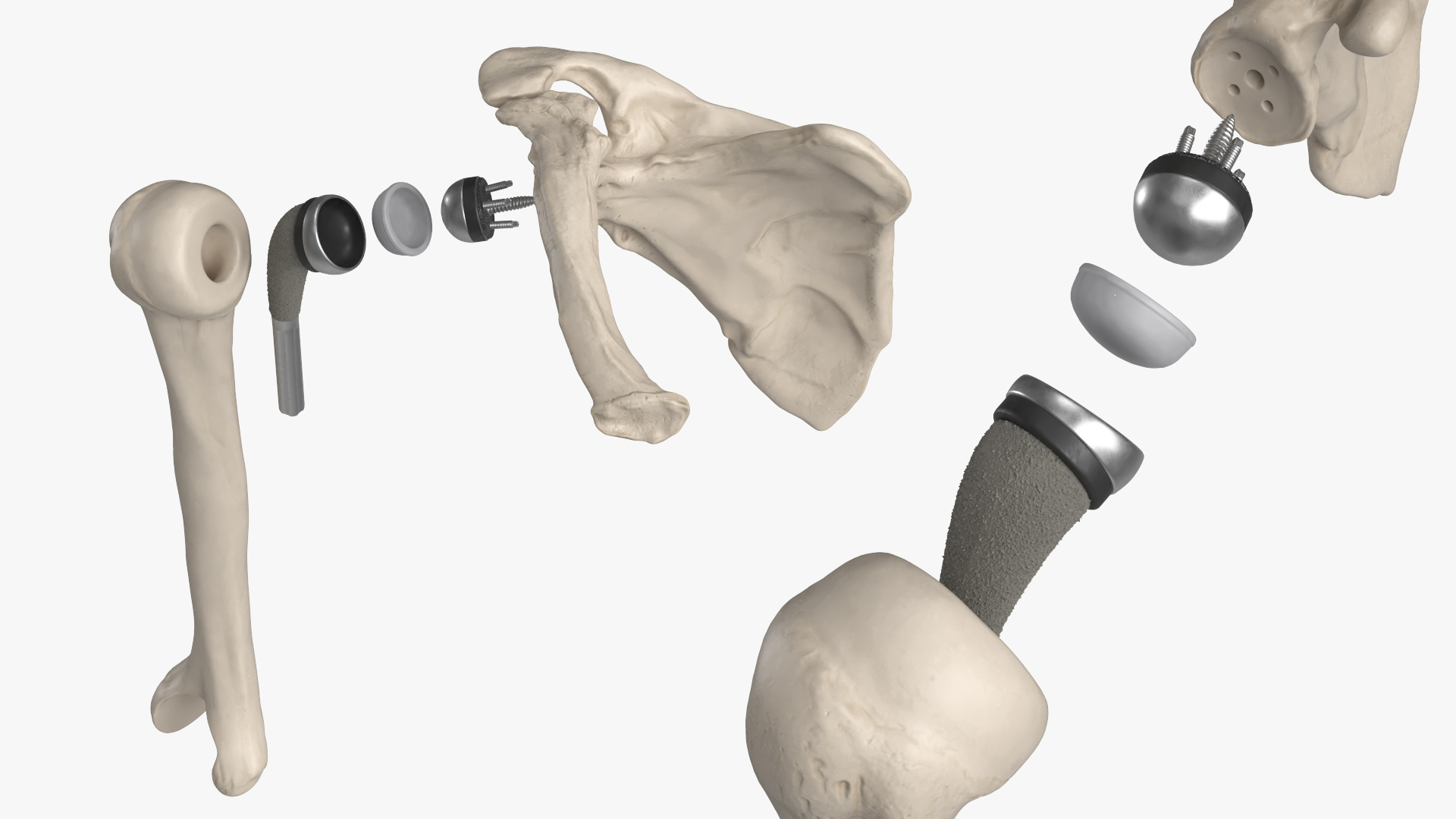 Shoulder Joint Implant with Humerus and Scapula, view 5
