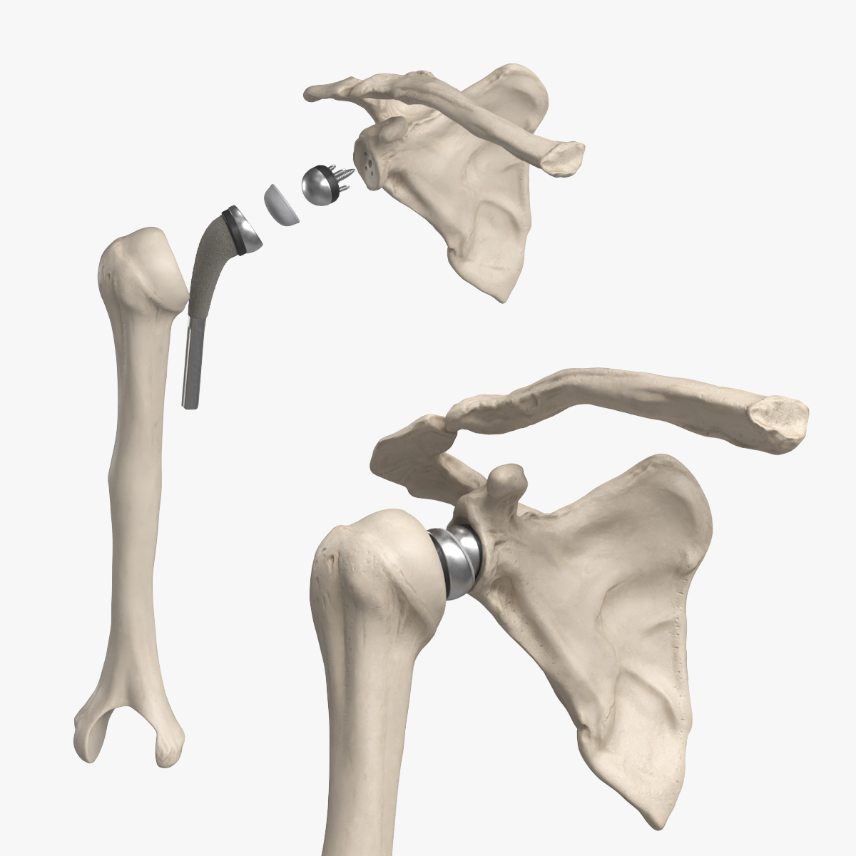 Shoulder Joint Implant with Humerus and Scapula 3D model preview