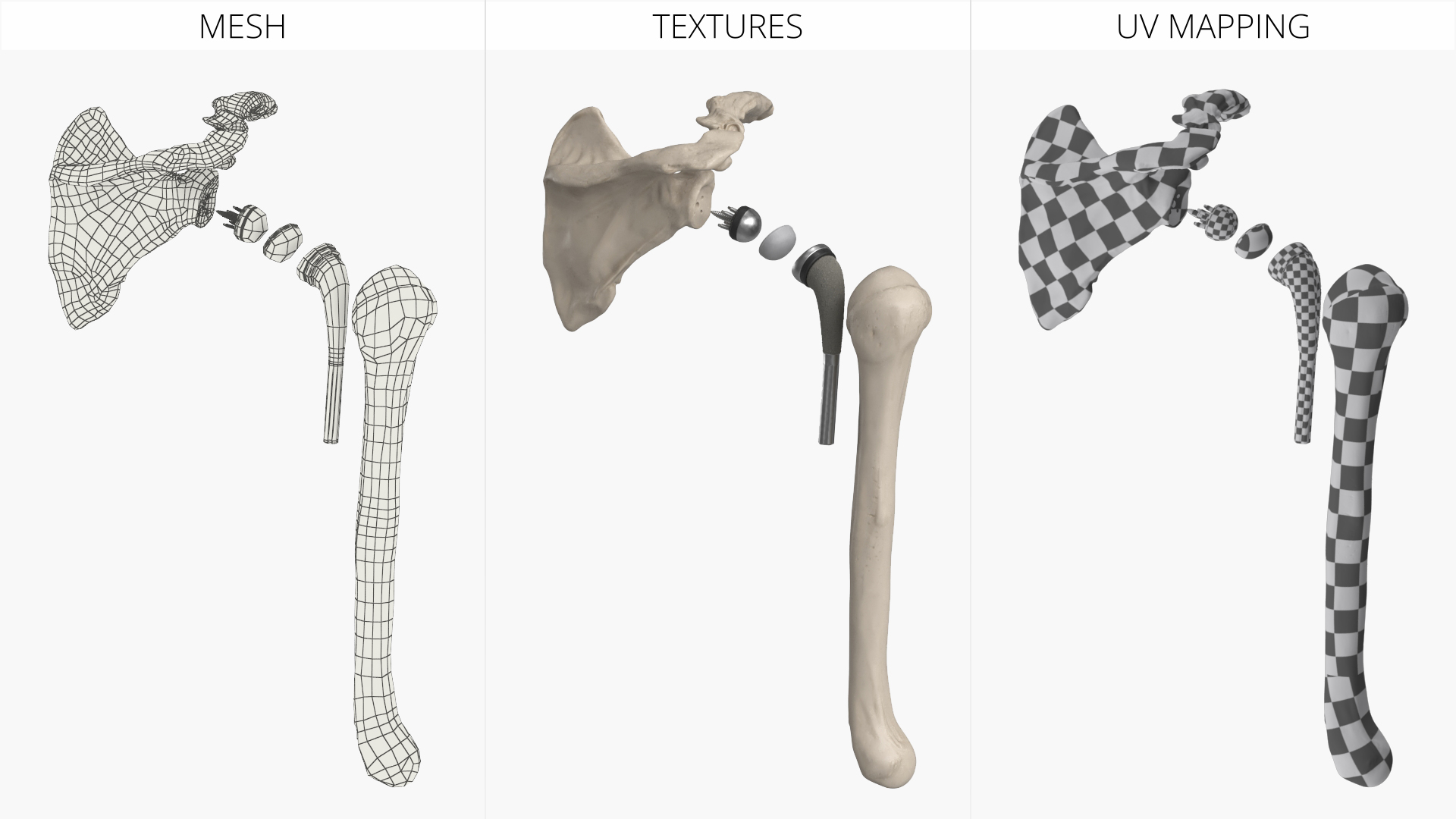 Shoulder Joint Implant with Humerus and Scapula, view 8