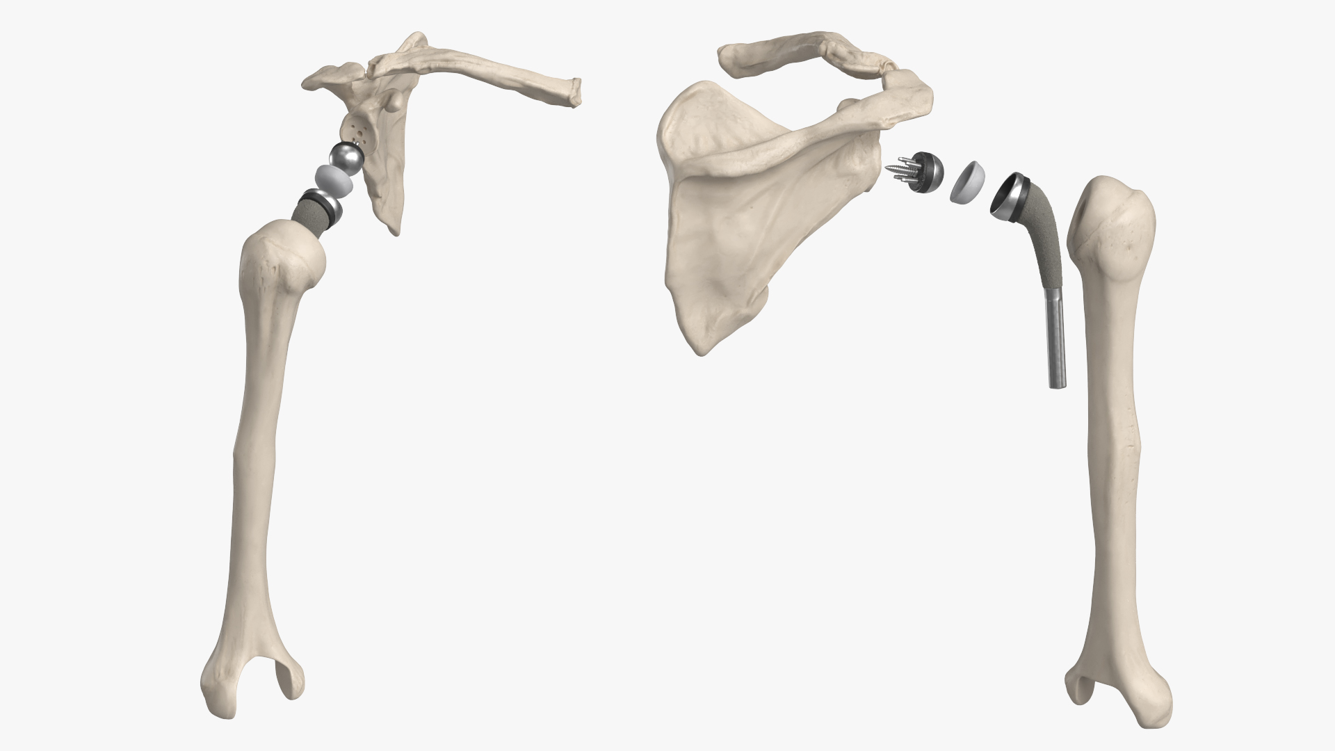 Shoulder Joint Implant with Humerus and Scapula, view 3