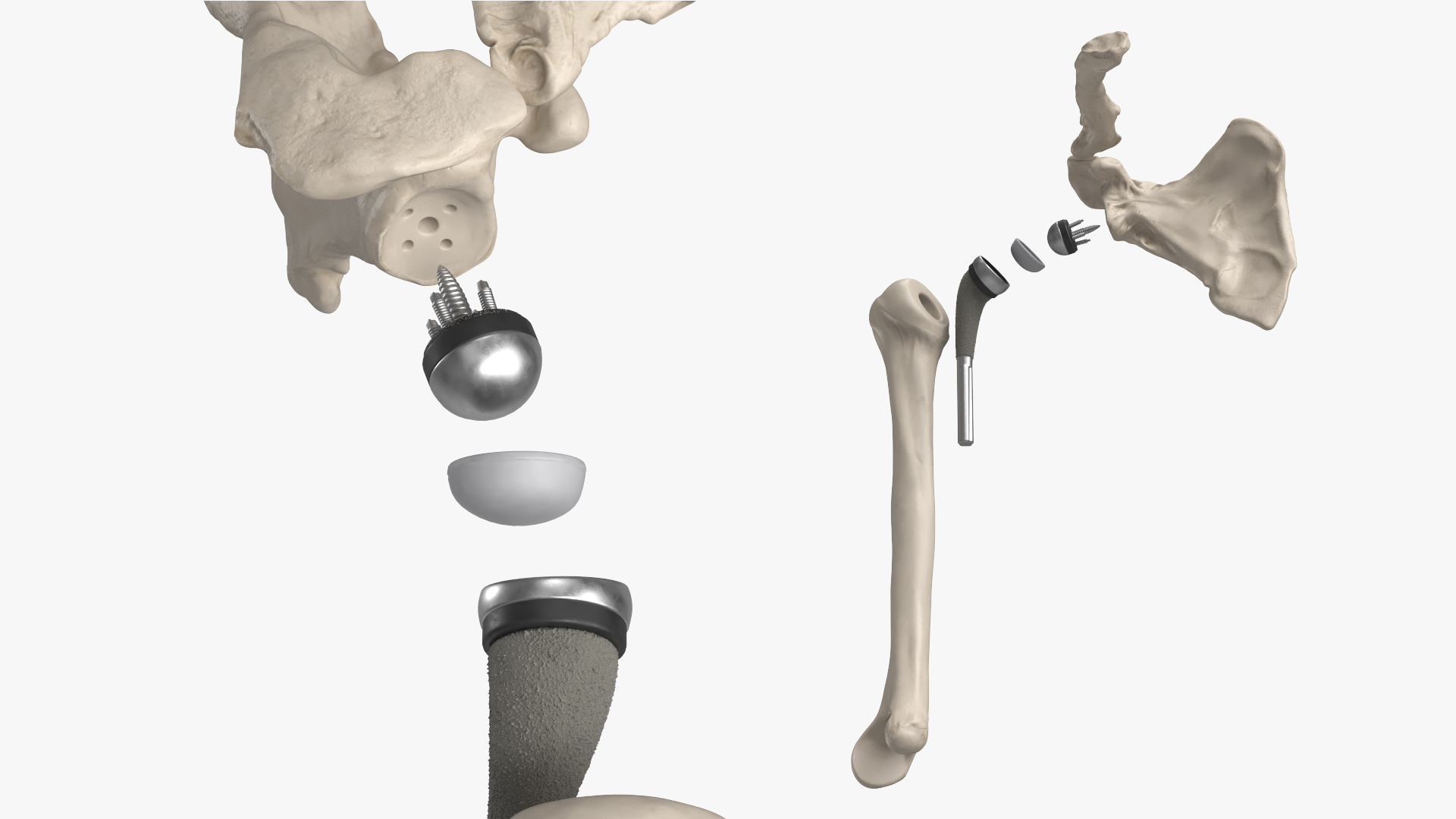 Shoulder Joint Implant with Humerus and Scapula, view 4