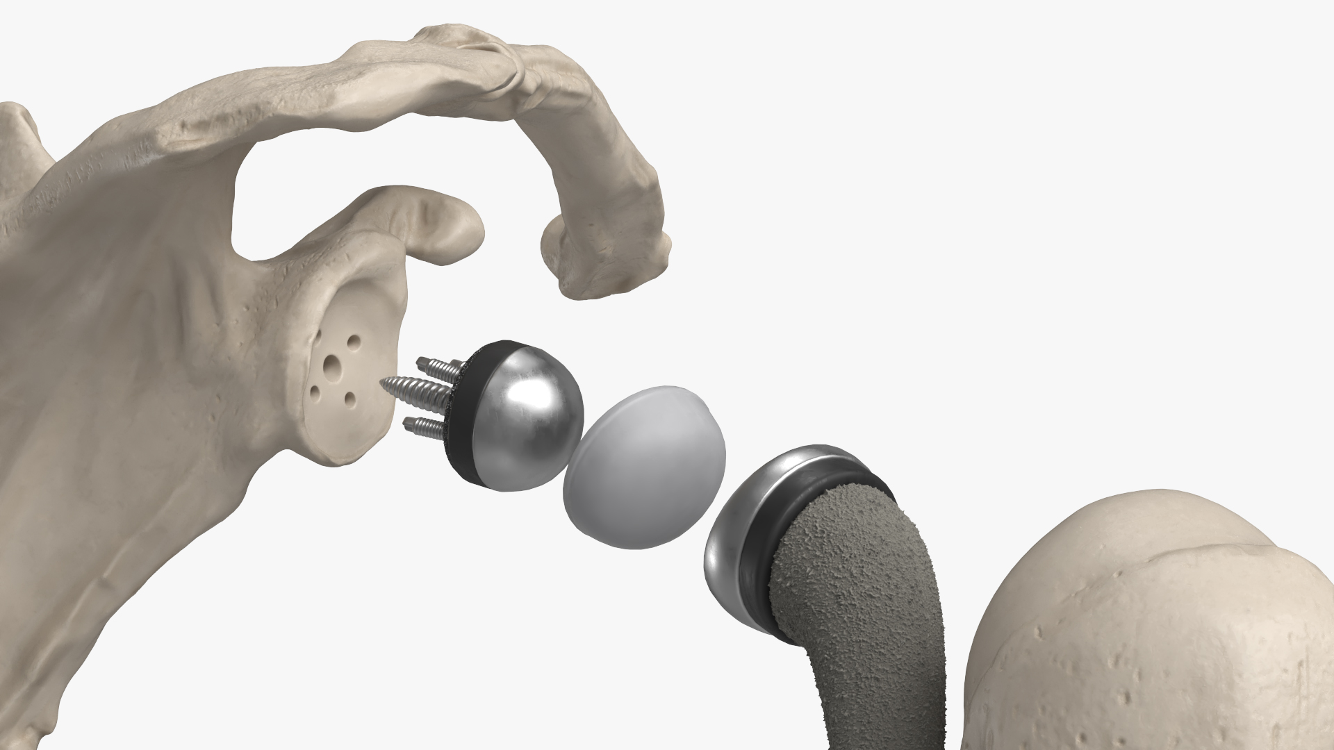 Shoulder Joint Implant with Humerus and Scapula, view 6