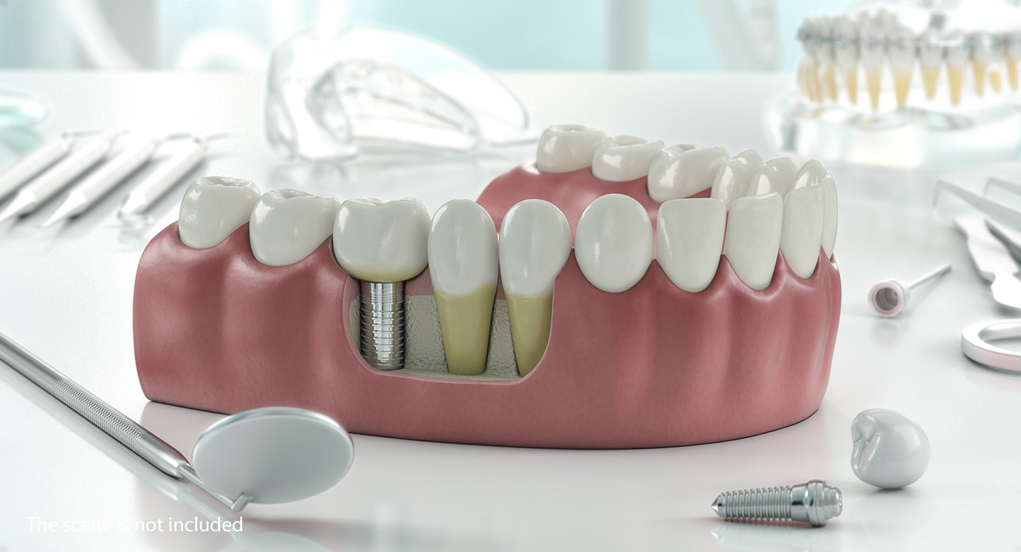 3D model Lower Teeth Medical Model With Dental Implant