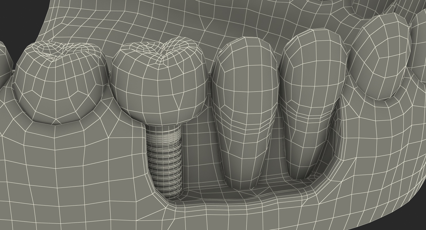 3D model Lower Teeth Medical Model With Dental Implant