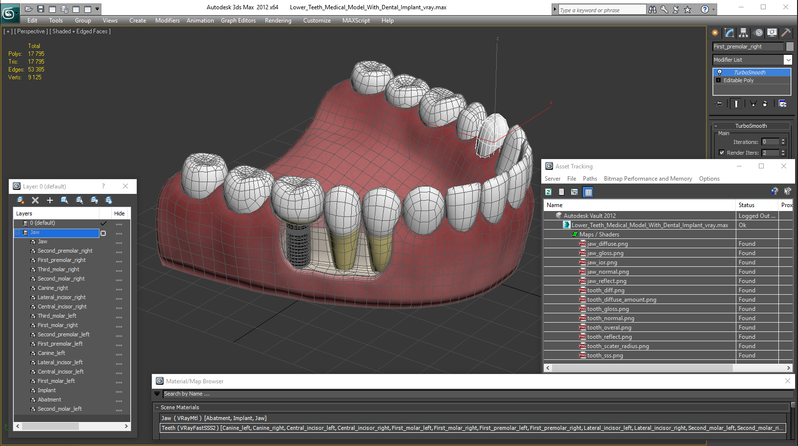 3D model Lower Teeth Medical Model With Dental Implant