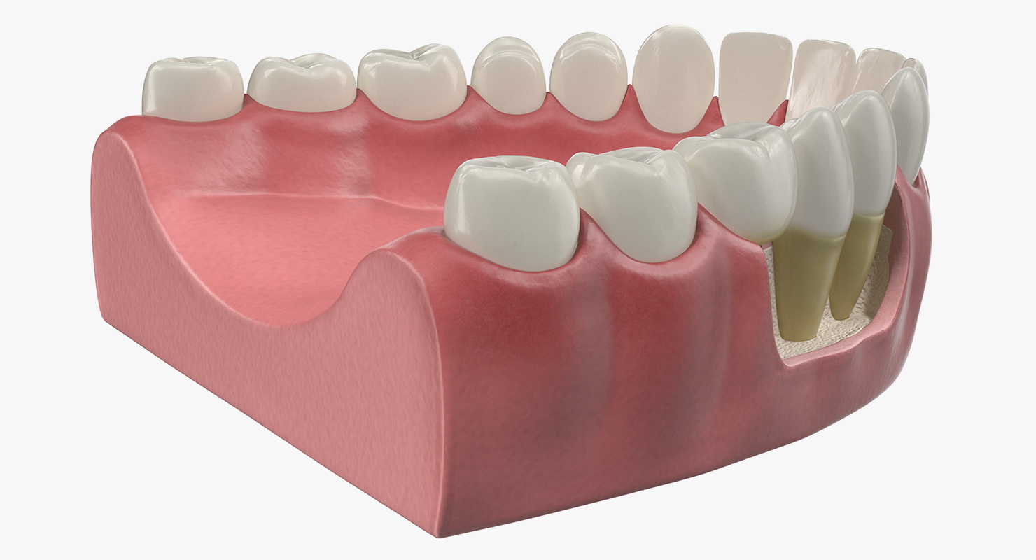 3D model Lower Teeth Medical Model With Dental Implant