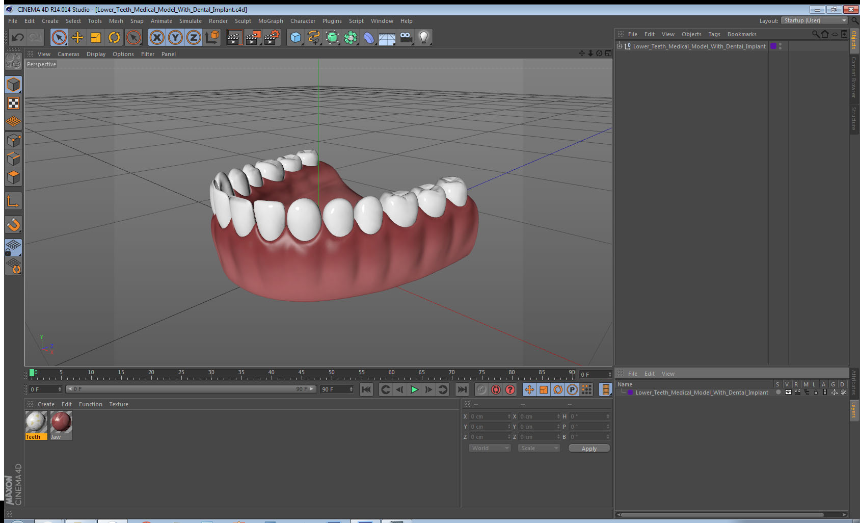 3D model Lower Teeth Medical Model With Dental Implant