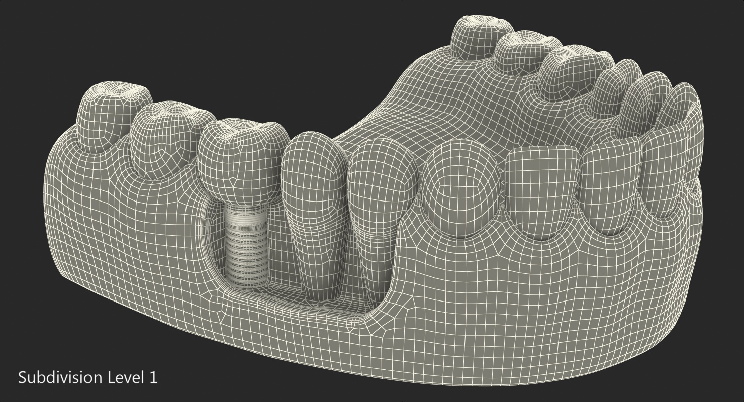 3D model Lower Teeth Medical Model With Dental Implant