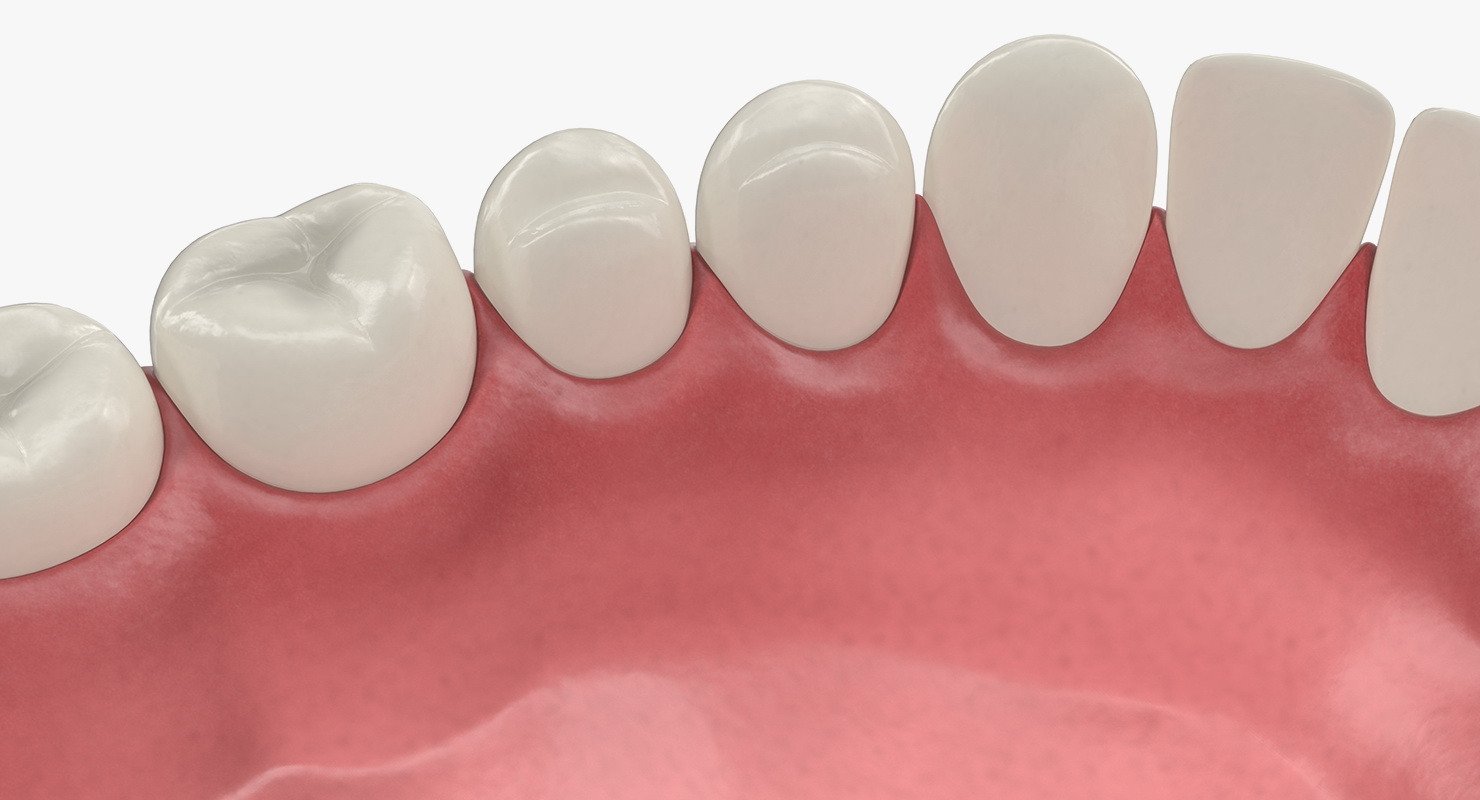 3D model Lower Teeth Medical Model With Dental Implant