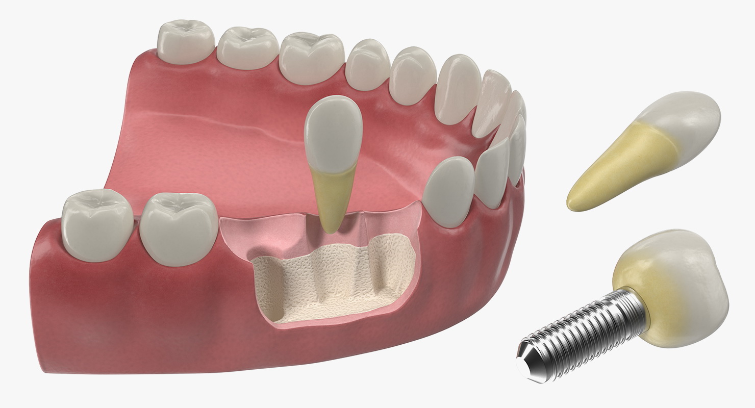 3D model Lower Teeth Medical Model With Dental Implant