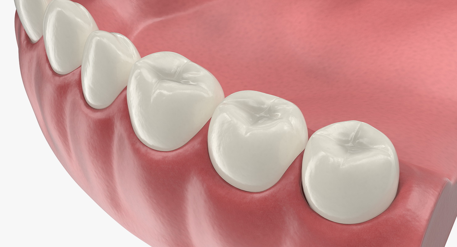 3D model Lower Teeth Medical Model With Dental Implant