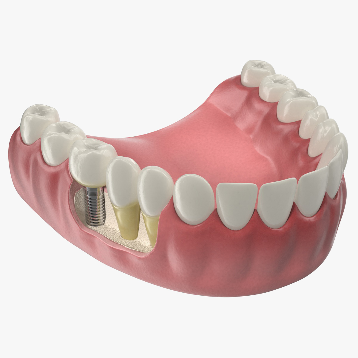 Lower Teeth Medical Model With Dental Implant, view 3