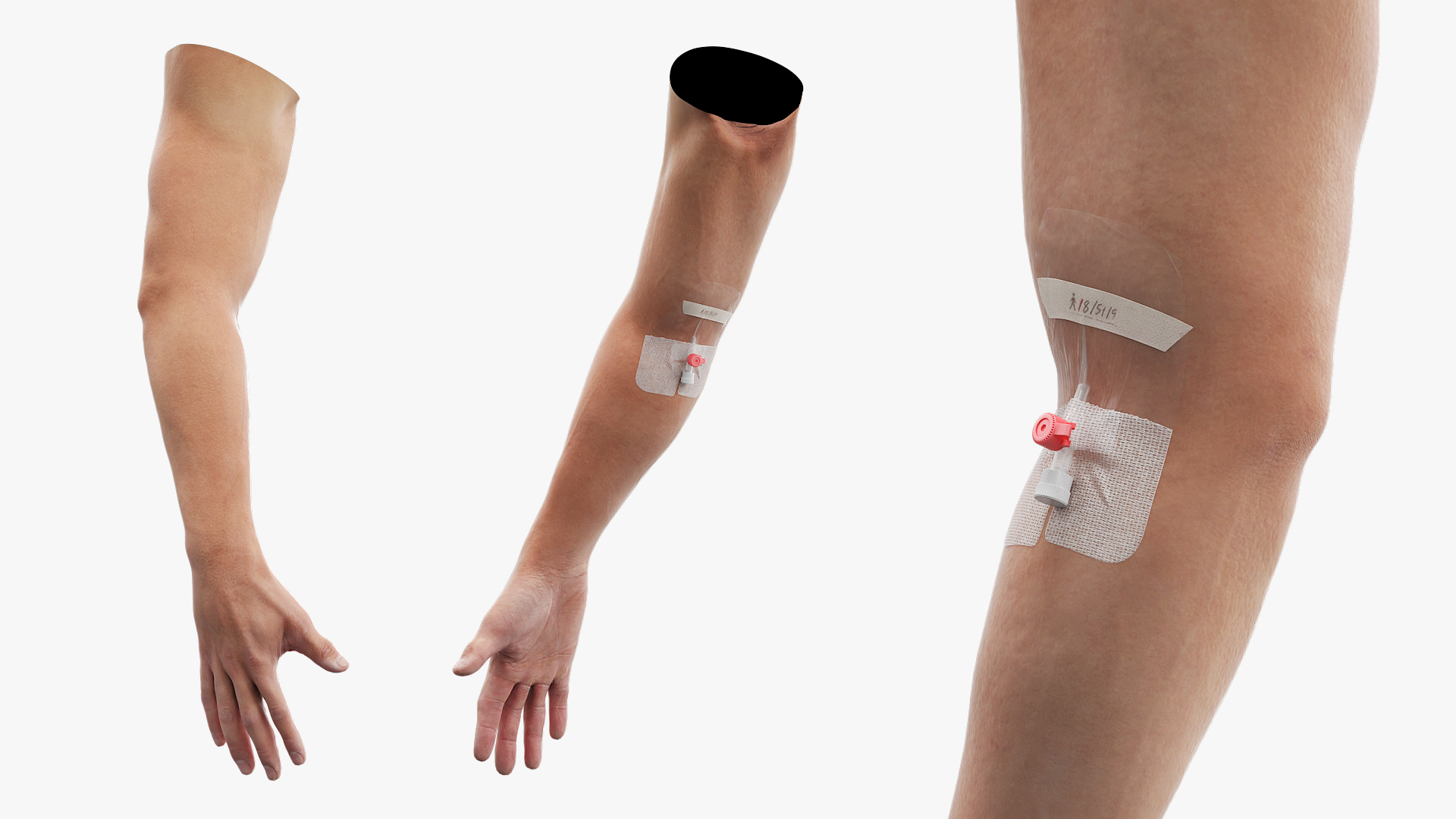 Venous Access Device with Forearm Fixation - view 4