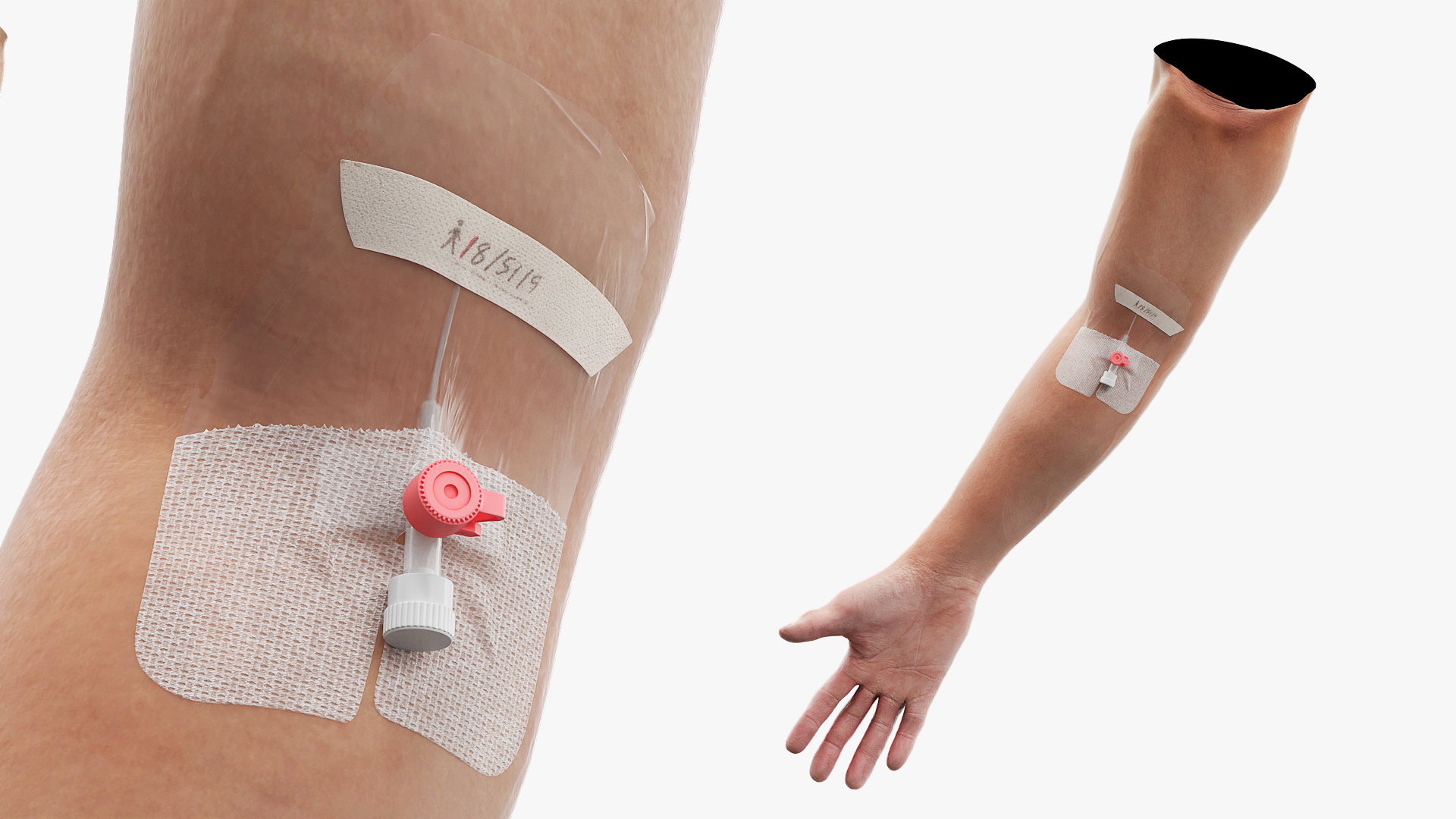 Venous Access Device with Forearm Fixation - view 2