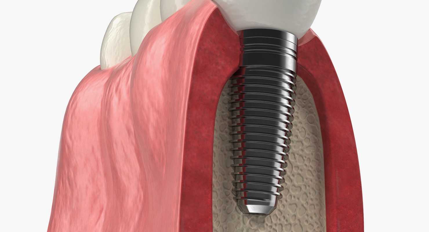 Education Tooth Implant Model 3D model