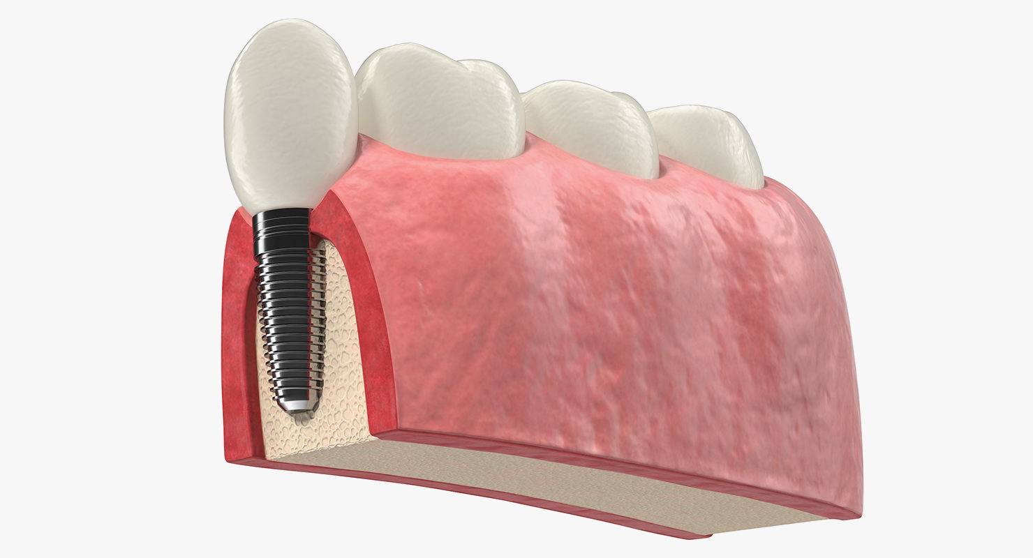 Education Tooth Implant Model 3D model