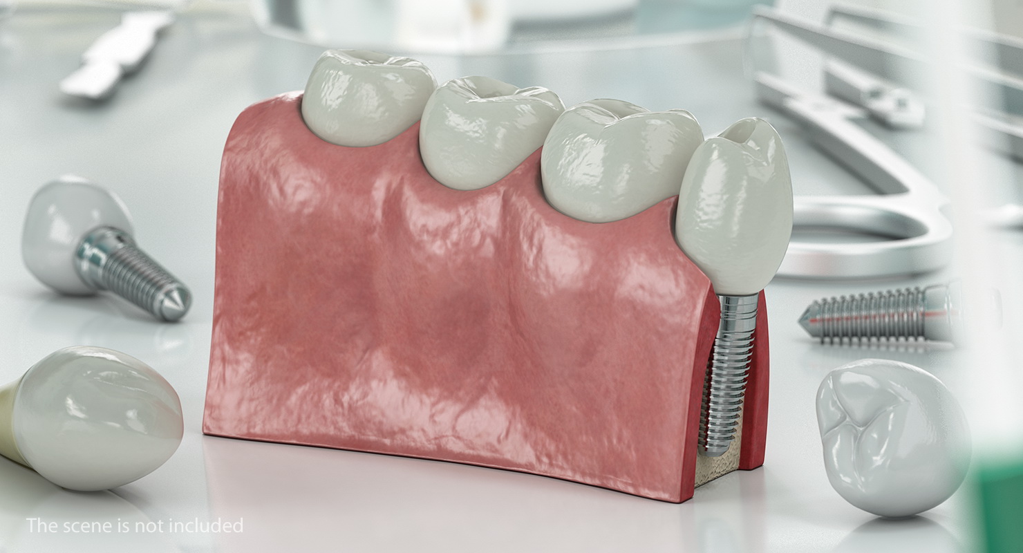 Education Tooth Implant Model 3D model