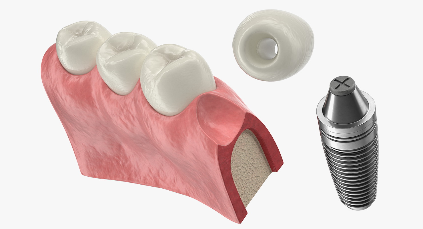 Education Tooth Implant Model 3D model