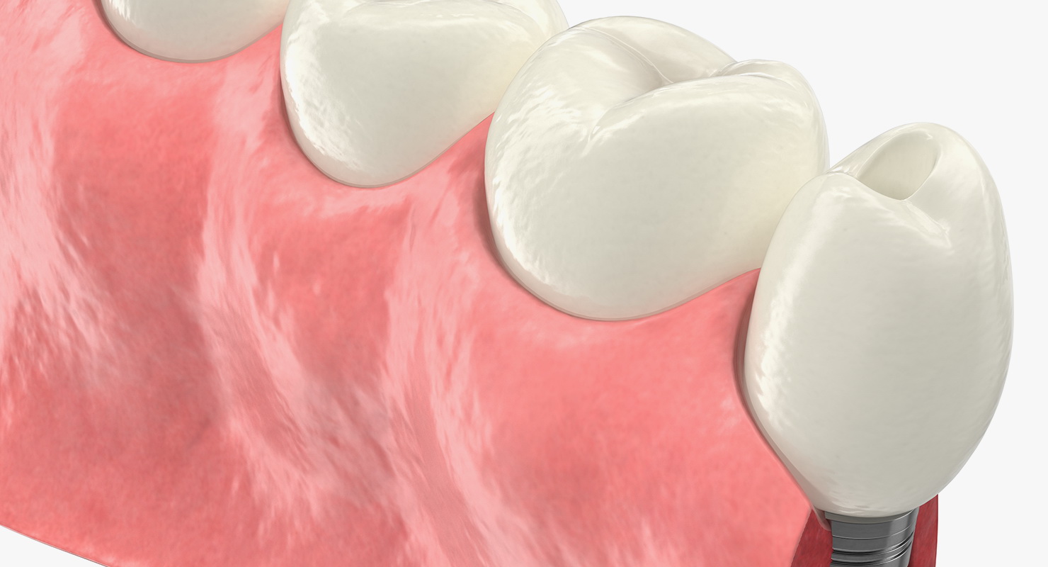 Education Tooth Implant Model 3D model