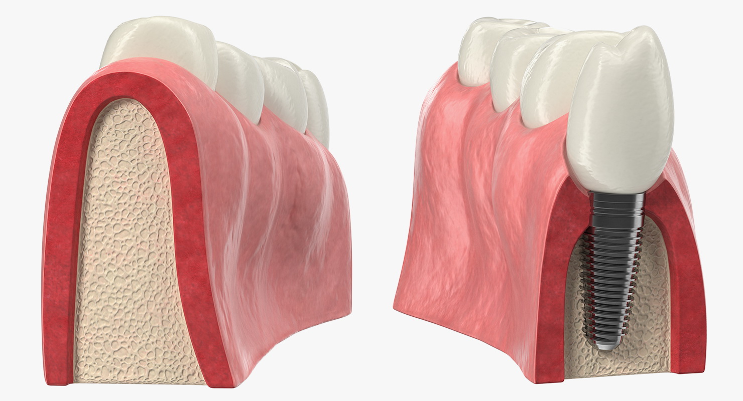 Education Tooth Implant Model 3D model