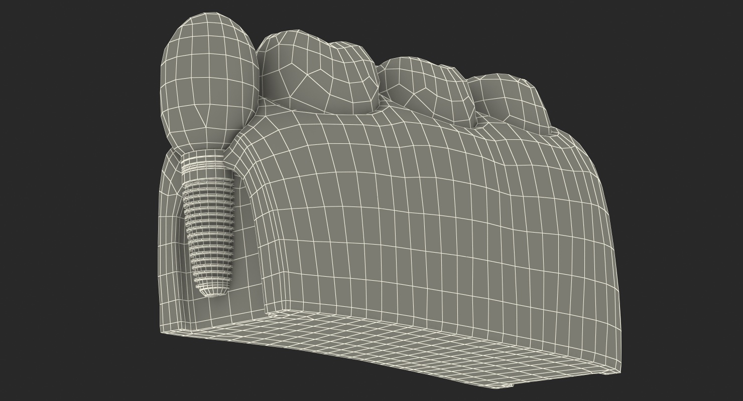 Education Tooth Implant Model 3D model