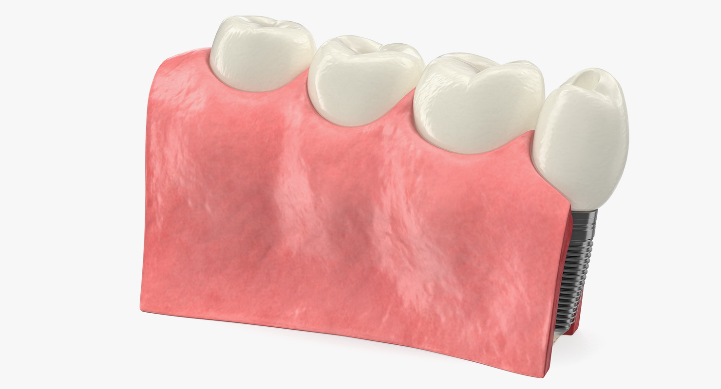 Education Tooth Implant Model 3D model
