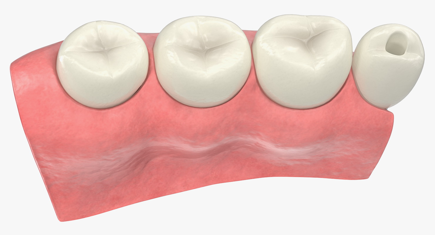 Education Tooth Implant Model 3D model