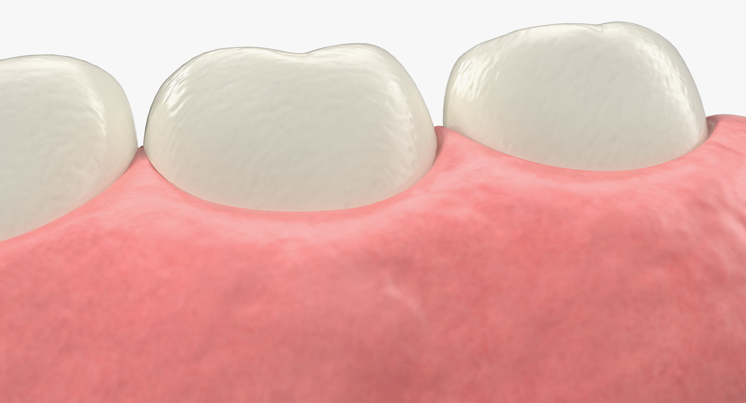 Education Tooth Implant Model 3D model