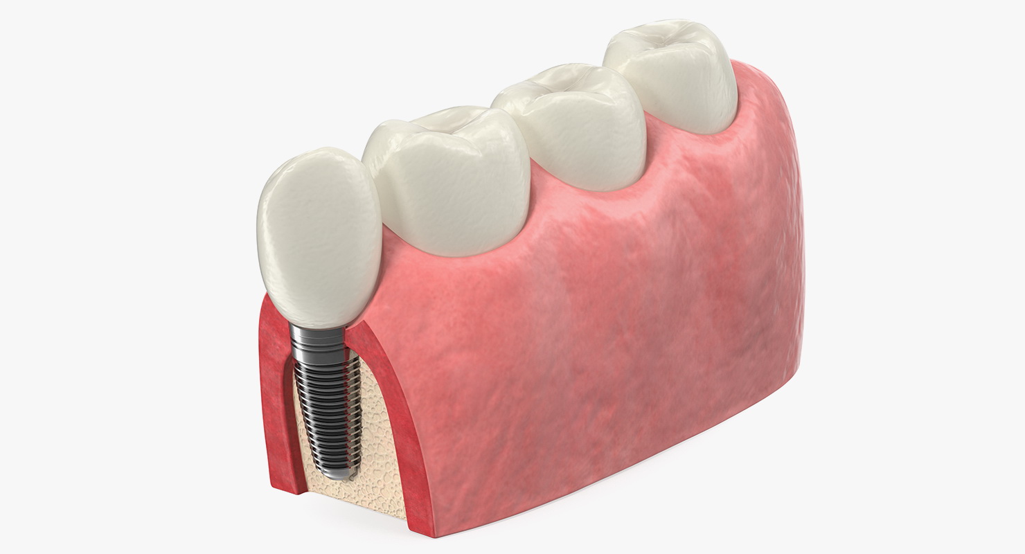Education Tooth Implant Model 3D model