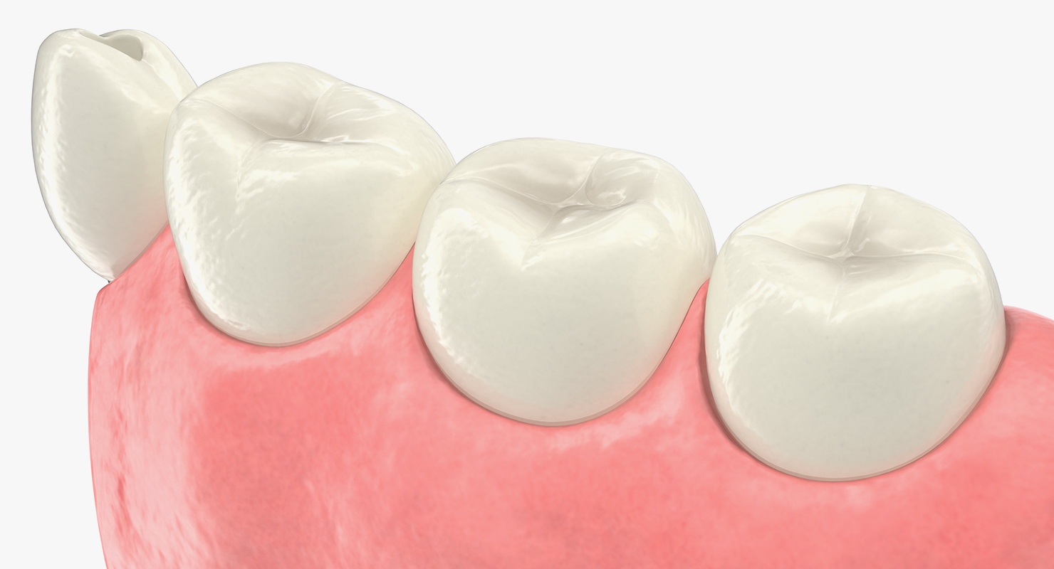Education Tooth Implant Model 3D model