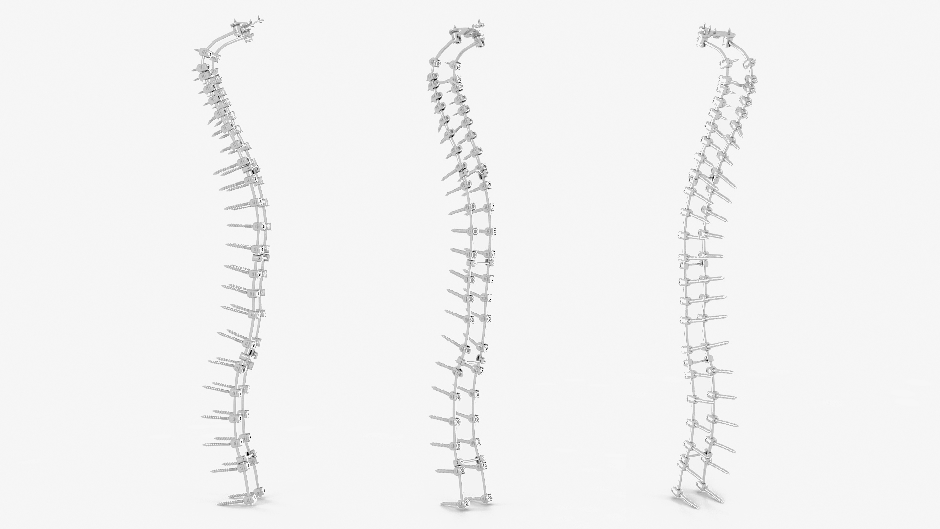 3D Spine Fixation System
