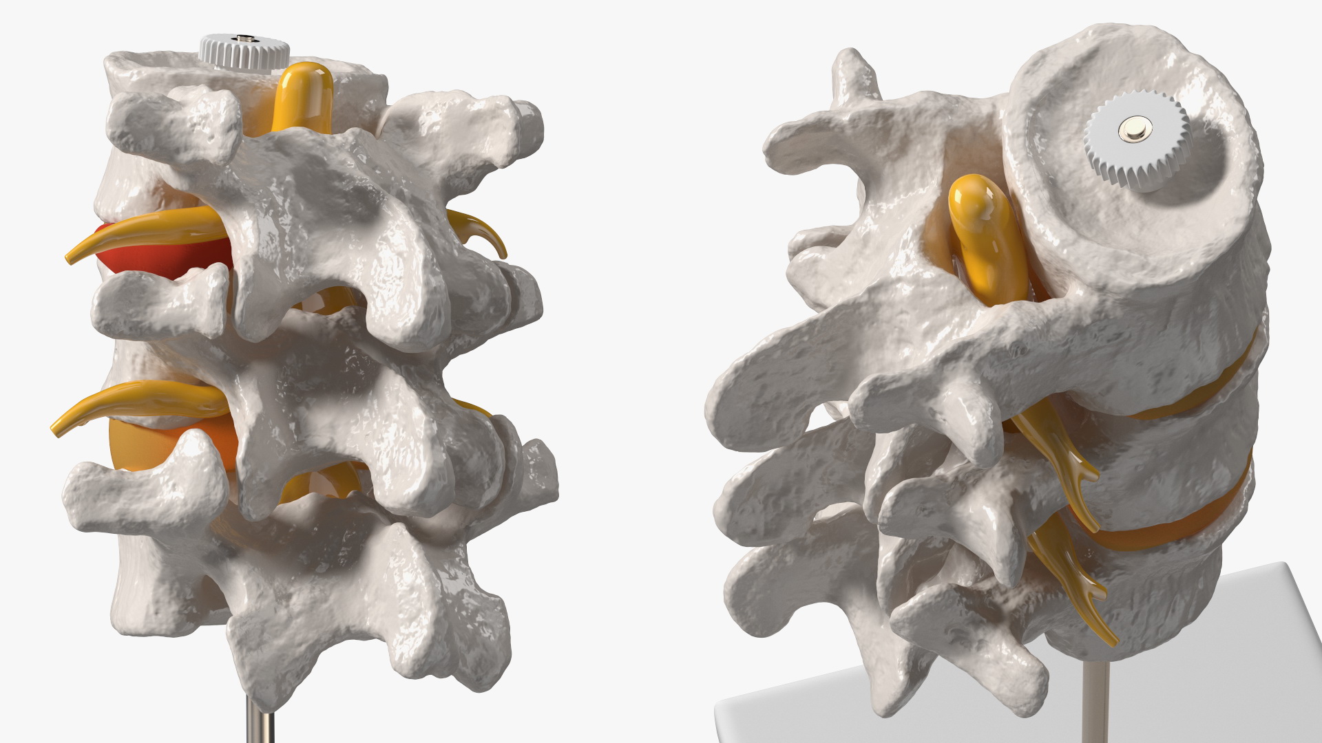 3D Herniated Vertebrae on Medical Stand