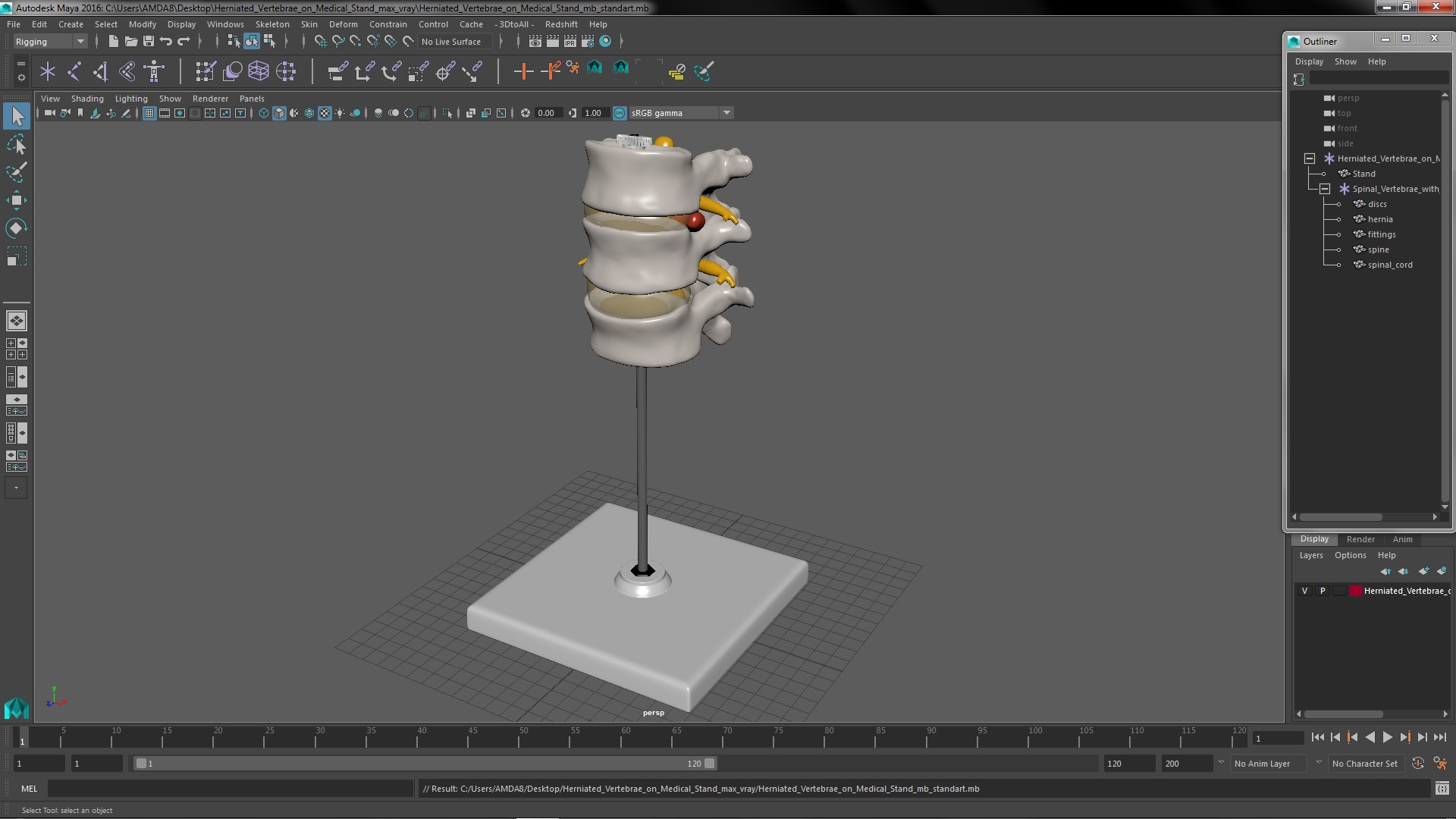 3D Herniated Vertebrae on Medical Stand